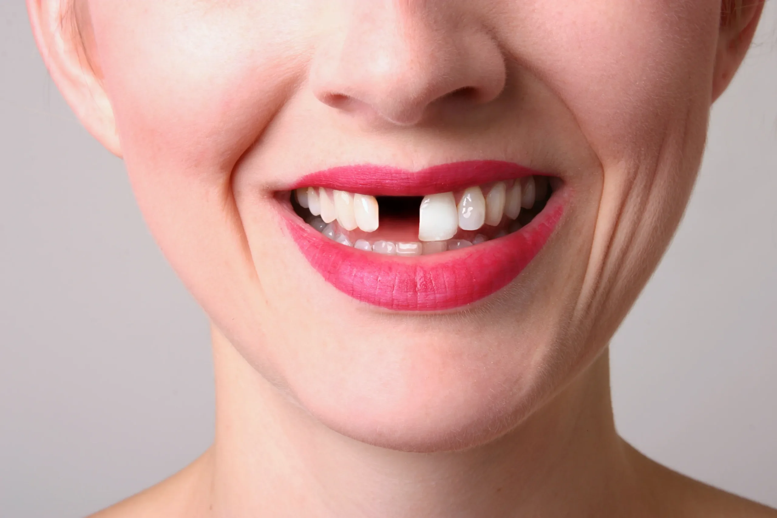 The Ultimate Guide to Replacing Two Missing Back Teeth with Insurance