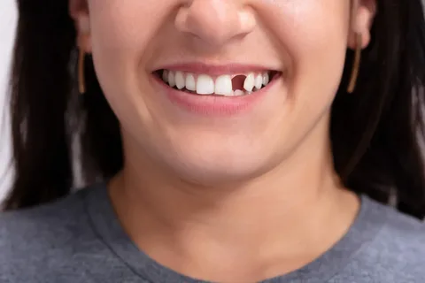 Best Options for Missing Two Back Teeth with Insurance