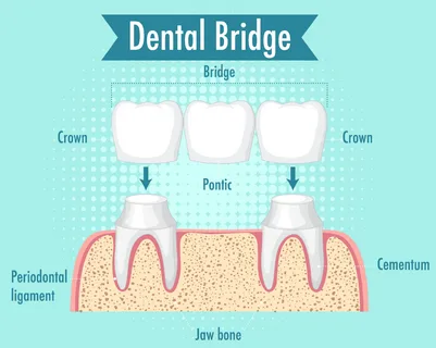 Cost of Dental Bridges with Insurance: A Comprehensive Guide